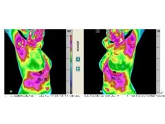 医用热成像测血栓图1